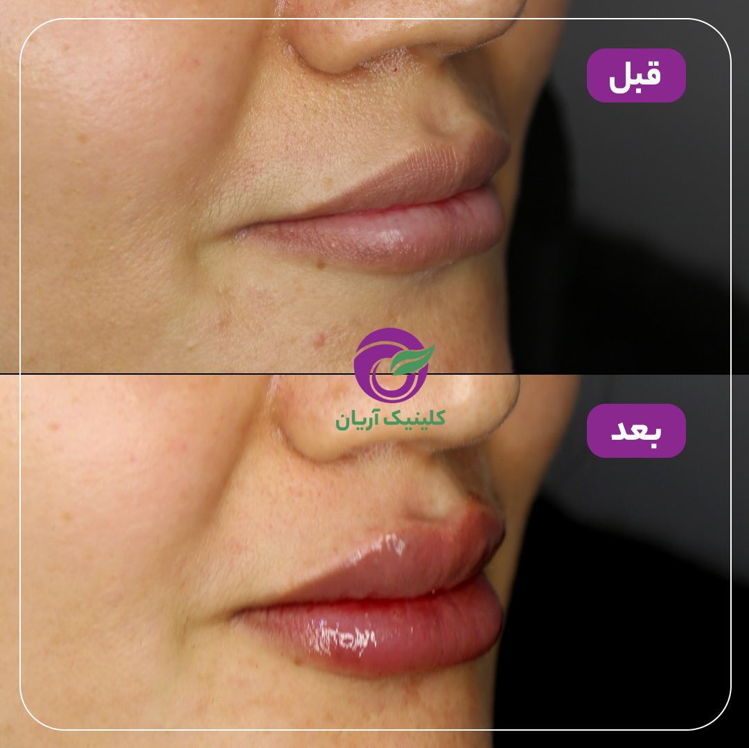 تصاویر قبل و بعد از تزریق ژل